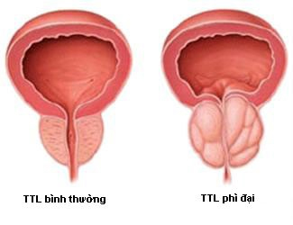 Phì đại tiền liệt tuyến: nguyên nhân, triệu chứng và cách xử lý