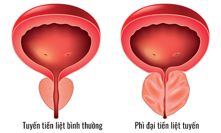 Phì đại tiền liệt tuyến: nguyên nhân, triệu chứng và cách xử lý